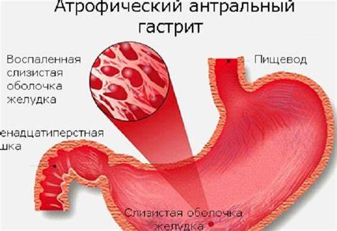 Атрофический гастрит: лечение народными средствами атрофического Картинка - Атрофический гастрит: лечение народными средствами атрофического