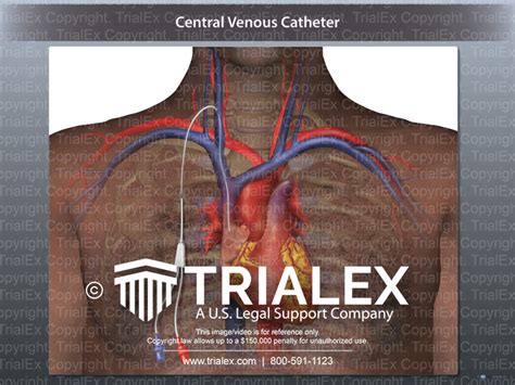Central Venous Catheter Trialexhibits Inc