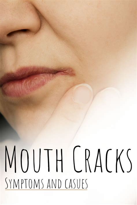 Mouth Corner Cracks Vitamin Deficiency In 2022 Cracked Corners Of Mouth Mouth Sores Sores