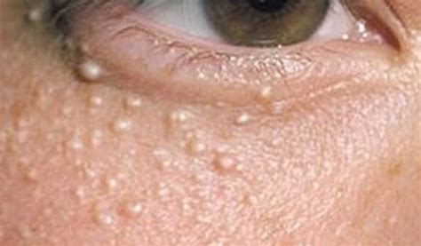 Bumps Under Eyes Meaning Milia Dots Causes Hard Cholesterol Dots