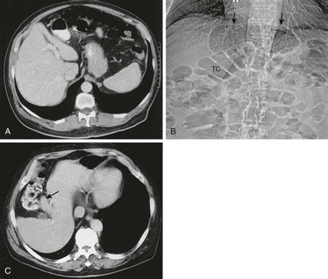 Anomalies And Anatomic Variants Of The Liver Radiology Key