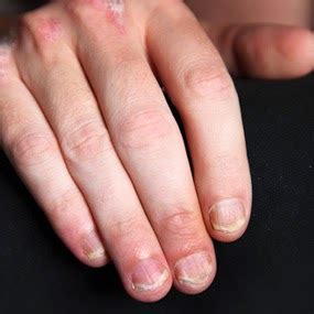 Check spelling or type a new query. Macam-macam jenis penyakit kulit psoriasis, beserta gejala ...