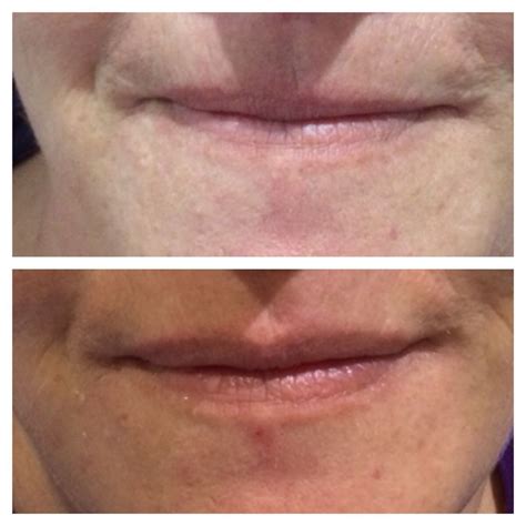 Botox Can Be Used In The Upper Lip To Enhance The Shape Visit Us At Our Leeds Clinic Botox
