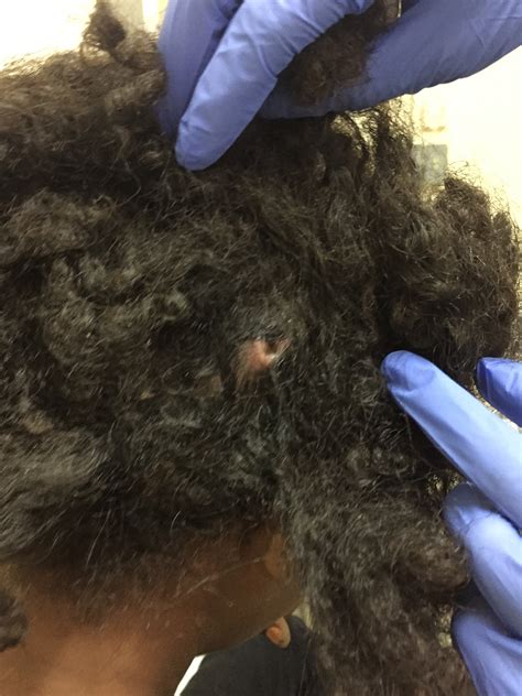 Myasis atau belatungan adalah infestasi larva lalat ke dalam suatu jaringan hidup. Myiasis!!! « Issa Trust Foundation