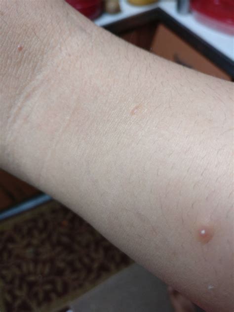 What Is This Ive Had This Pimple On My Arm For A Few A While Now