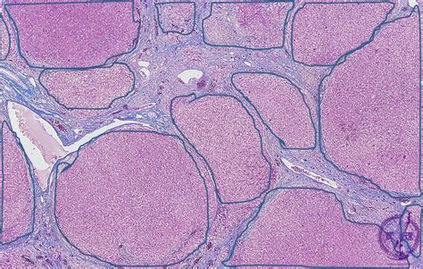 10liver 1 Viral Hepatitis Cirrhosispathology Core Pictures