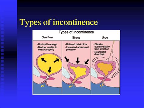 Ppt Incontinence And Prolapse Powerpoint Presentation Free Download
