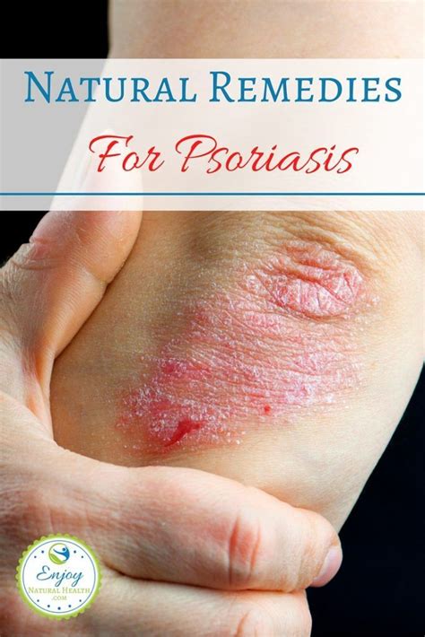 5 Natural Remedies For Psoriasis With Images Psoriasis Remedies