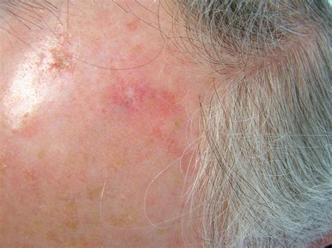 Keratosis Skin Cancer On Face