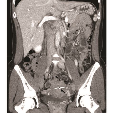 Case 2 Gallstone In Duodenum Removed By Ercp Sphincterotomy Balloon