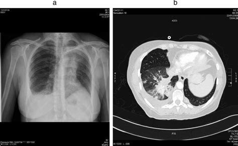 Tumor Progression ‘‘flare Up Documented By Chest Radiograph A And