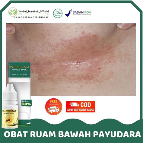 Jual Obat Ruam Merah Di Bawah Payudara Biang Keringat Gatal Panas