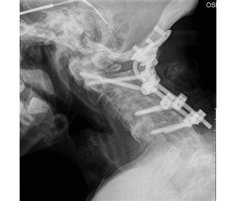 Postoperative Lateral Radiograph Demonstrating An Occiput To C4 Fusion