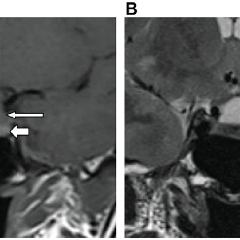 Rcc Intracystic Nodules Observed Using Mri Case Numbers Correspond