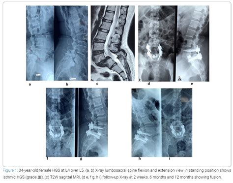 Surgical Management Of Adult High Grade Spondylolisthesis By Partial