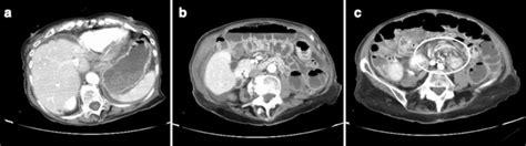Small Bowel Obstruction Caused By Volvulus After Adhesional Bands