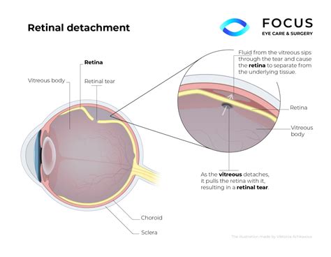 Retinal Detachment Queens Nyc And Long Island Ny