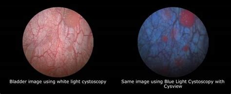 Blue Light Cystoscopy With Cysview Brigham And Womens Faulkner Hospital