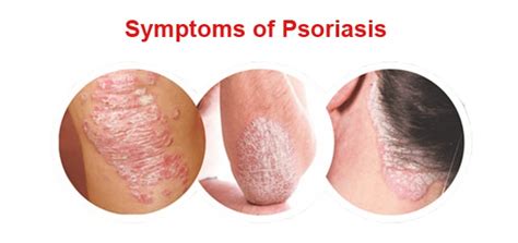 What Is Psoriasis Symptoms Causes And Treatment