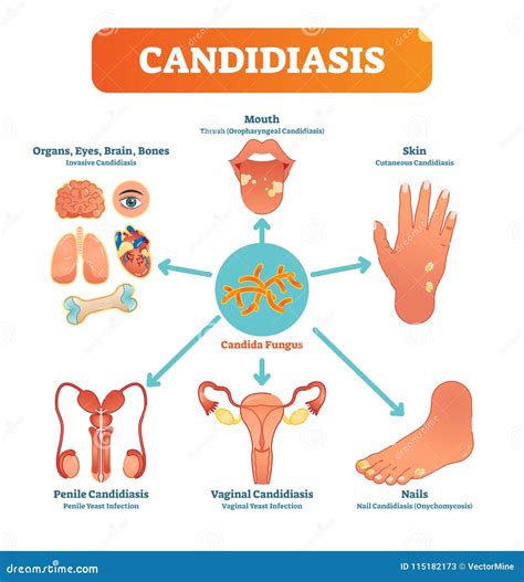 Candidiasis Medical Vector Illustration Diagram Poster With All Types Of Candida Fungus On