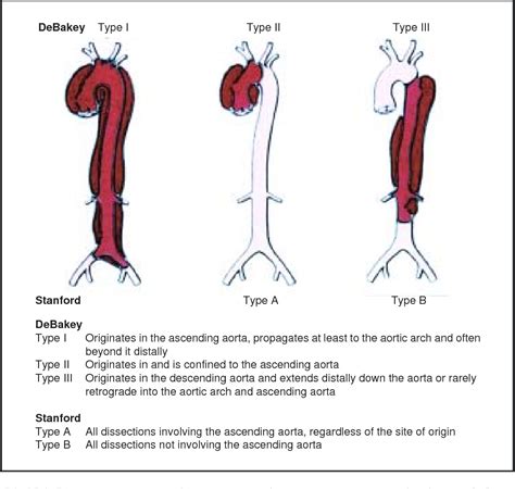 Figure 3 From Acute Aortic Syndromes And Thoracic Aortic Aneurysm