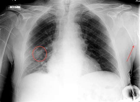Check spelling or type a new query. Lung cancer with bone metastasis - Radiology at St ...