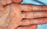 Rocky Mountain spotted fever causes, symptoms, rash and treatment