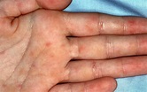 Rocky Mountain spotted fever causes, symptoms, rash and treatment