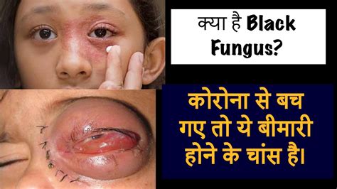 Corona से तो बच गए Mucormycosis से कैसे बचेंगे Black Fungus Kya Hai