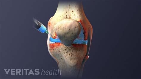 Therapeutic Injections For Knee Arthritis