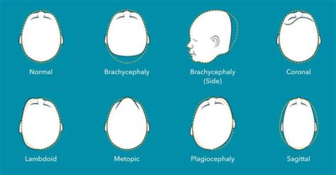 Deformational Plagiocephaly Flat Head Syndrome Gillette Childrens