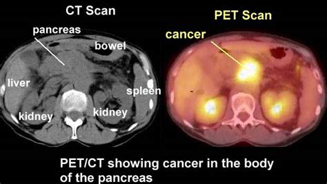 Pet Scans In Cancer Cases
