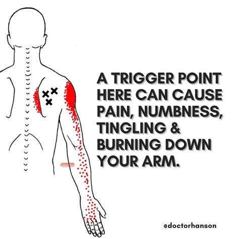 Trigger Points In The Shoulder Can Cause Numbness In The Hand