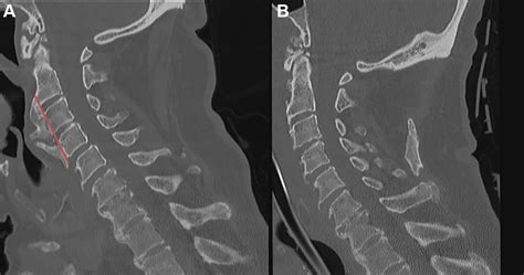 Anterior Cervical Osteophyte Resection For Treatment Of Dysphagia