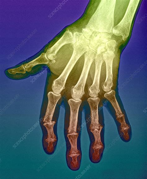 Arthritic Hand X Ray Stock Image C0269056 Science Photo Library