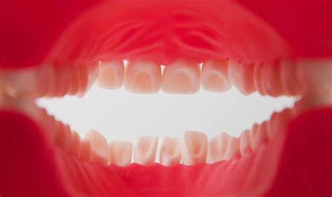 ¿por Qué Se Desgastan Los Dientes Principales Causas Y Tratamiento