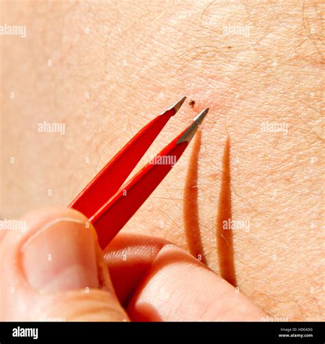 Removing A Tick With Tweezers From Skin Stock Photo Alamy