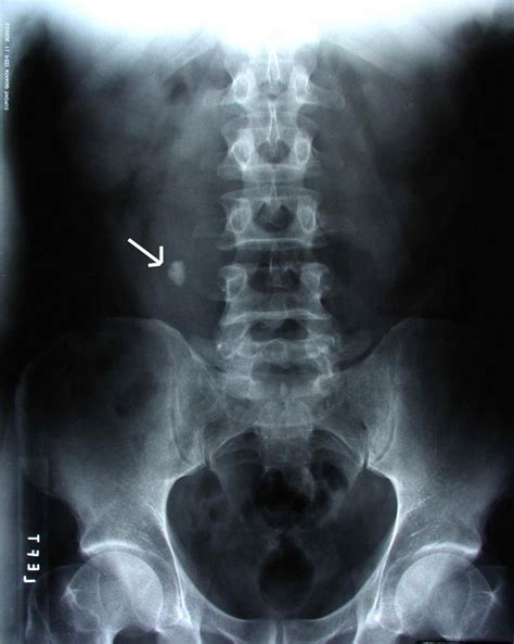 X Ray Photos Of Kidney Stones