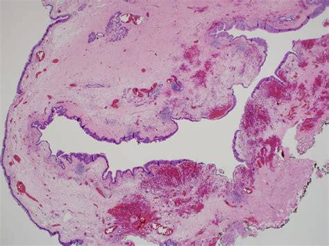 Laryngocele Saccular Cyst With Histopathology Laryngocoele Iowa