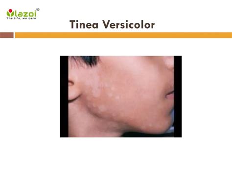 Ppt Tinea Versicolor Symptoms Causes Diagnosis And Treatment