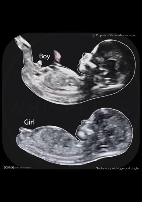 Your First Ultrasound Can Tell The Gender Of Your Baby Ur Baby Blog