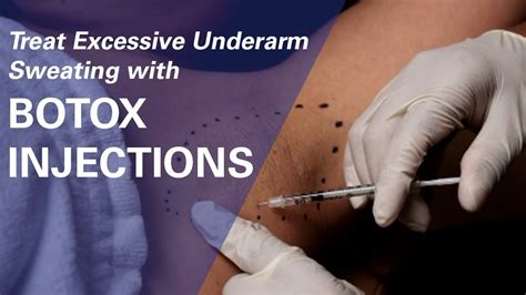 Botulinum toxin requires binding to zinc in order to function. Using Botox for Excessive Sweating in Underarms - ZO Skin ...