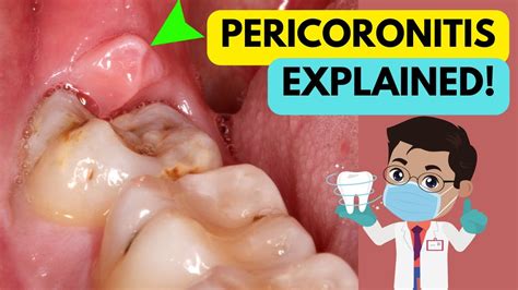Pericoronitis Explained In 5 Minutes Cause Symptoms Diagnosis And
