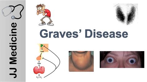 Graves Disease And Graves Ophthalmopathy Signs Symptoms Diagnosis