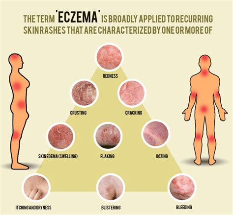 Brief Guidance On Different Types Of Eczematous Dermatitis Baby Care