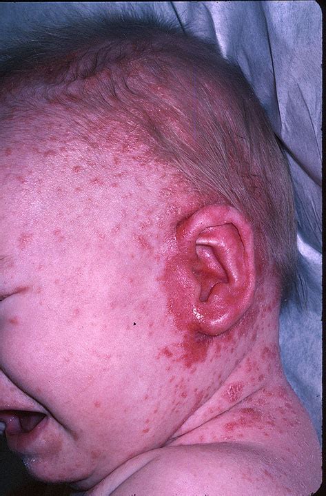 Seborrheic Dermatitis Cradle Cap Picture Hardin Md Super Site Sample
