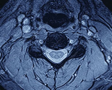 Vertebra And Spinal Cord Mri Scan Stock Image C0487134 Science