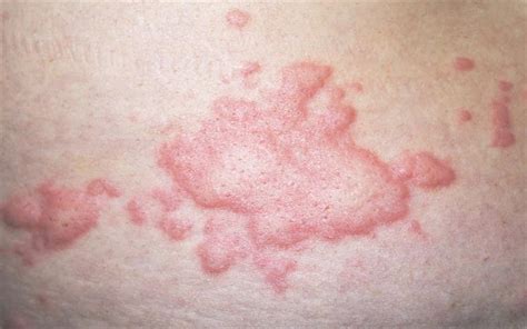 Treatment For Chronic Spontaneous Urticaria Approved By Nice Mims Online