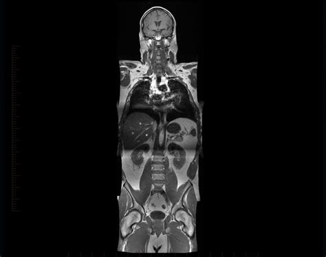 Full Body Mri Mri At Melbourne Radiology Clinic