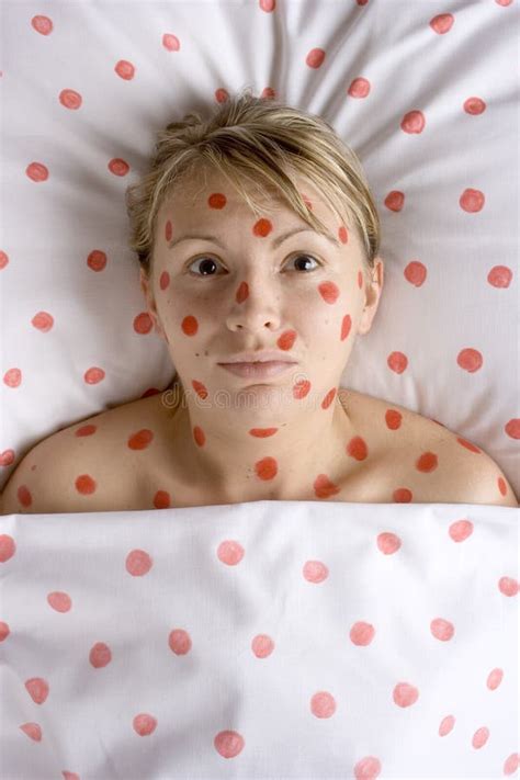 Woman With Red Spots On Face And Body Stock Image Image Of Bedroom